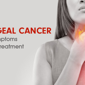 Oesophageal Cancer (Carcinoma): Overview, Symptoms, Causes and Treatment Oesophageal Cancer (Carcinoma): Overview, Symptoms, Causes and Treatment