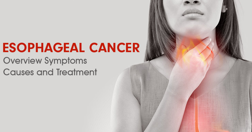 Oesophageal Cancer (Carcinoma): Overview, Symptoms, Causes and Treatment